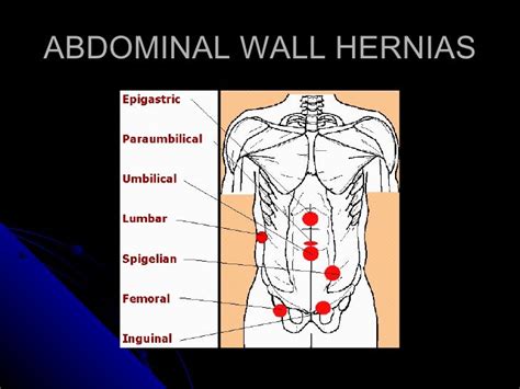 10 Abdominal Wall Defects Dr Fidel