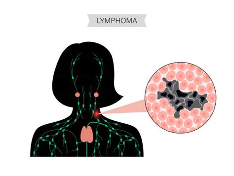 Lymphoma Cell Stock Photos Pictures And Royalty Free Images Istock