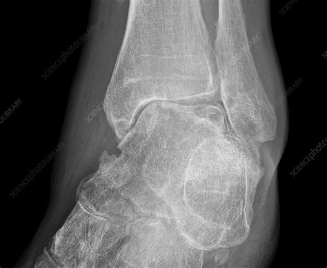 Ankle Osteoarthritis X Ray Stock Image C0533908 Science Photo