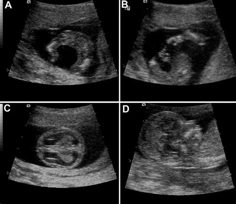 Prenatal Ultrasound At 15 Weeks Of Gestation Shows A Angulation And