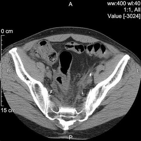 Bilateral Ureteric Obstruction An Unusual Complication Of
