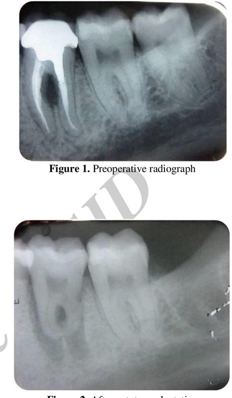 Figure 1 From Autotransplantation Of A Mature Mandibular Third Molar To