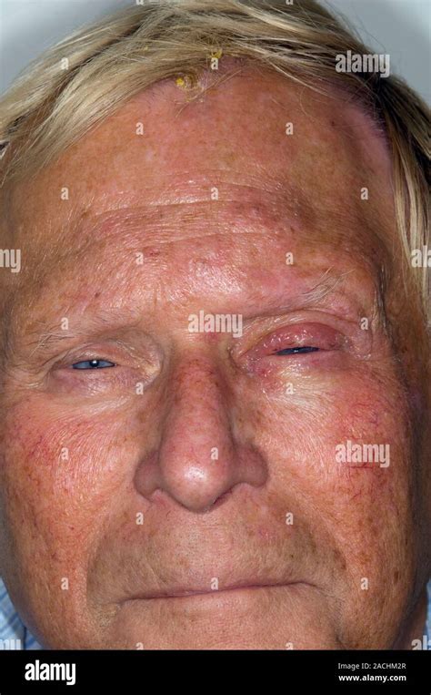 Shingles Rash On The Forehead With Eye Inflammation At Right In A 72