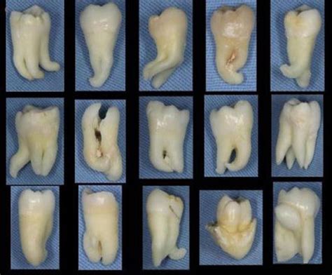 Various Kinds Of Roots In Molar Teeth Dental World Dental Life