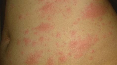 Covid Symptoms Kids Rash Face Coronavirus Uk Mum Warns Of Unusual