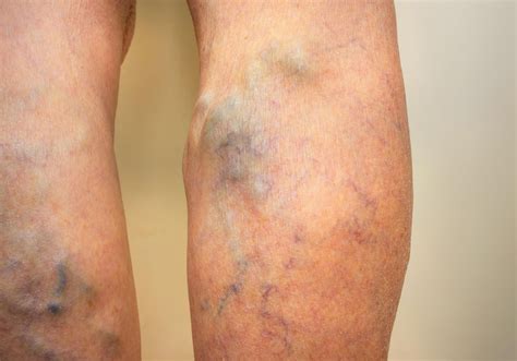 Are Athletes At Higher Risk Of Developing Varicose Veins The Vein