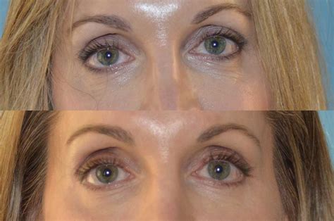 Before And After Park Avenue Oculoplastic Surgeons