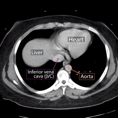 Abdominal Anatomy Ct Theradiologist On Twitter Annotated Abdominal Ct