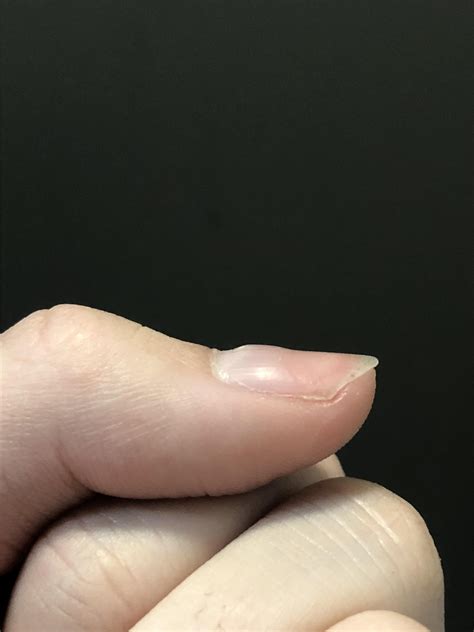 Whats With This Lump On My Fingernail Near The Back Of The Nail The