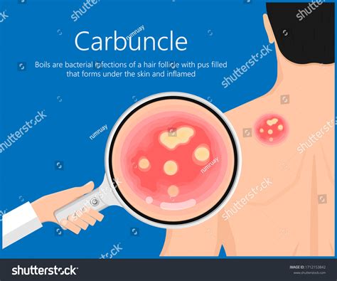 Carbuncle Boils Bacterial Infection Under Skin เวกเตอร์สต็อก ปลอดค่า