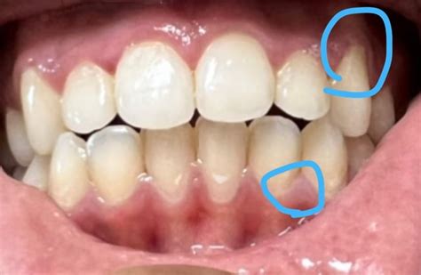 Gingivitis Or Vitamin Deficiencyanemia Gums Or A Mix Of All Symptoms