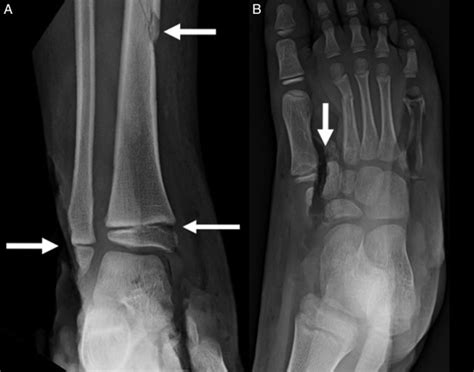 Reconstruction Of The Pediatric Lateral Malleolus And Physis By Free
