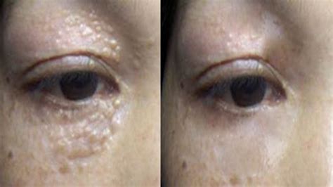 Milia Treatment 3 Weeks To Remove Milia And White Bumps Under Eyes By