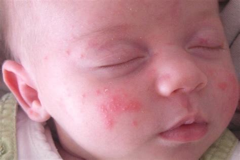 Buchstäblich „dünnhäutig erblickt ein baby das licht der welt. nealkhoerr: Rote Pusteln Im Gesicht Kleinkind