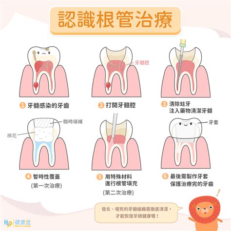 秒懂抽神經，根管治療不害怕！