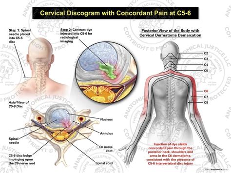 Female Left Cervical Discogram With Concordant Pain At C5 6