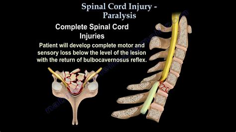 Spinal Cord Injury Paralysis Everything You Need To Know Dr