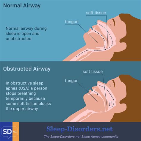 What Are The Different Types And Risk Factors Of Sleep Apnea