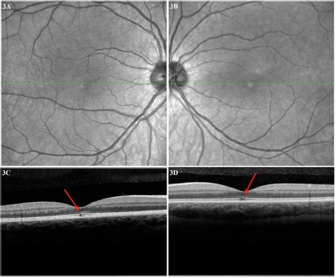 Case 3 A Right Eye Macula Red Free Oct Image And B Left Eye Macula
