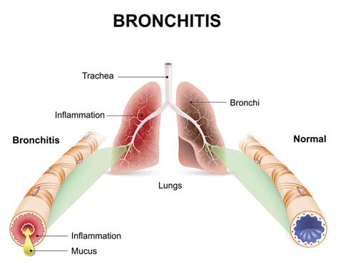 Like many other types of cancer, lung cancer may also cause systemic symptoms, like according to the american cancer society, unfortunately the majority of lung cancers do not cause any if you feel that something is wrong, be persistent with your doctor. Get Smart About Antibiotics | Bronchitis | Chest Cold | CDC