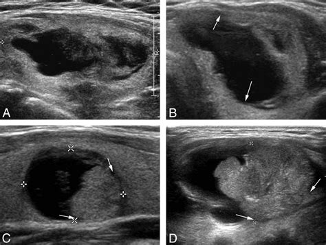 Fig 1 Sonographic Differentiation Of Partially Cystic Thyroid