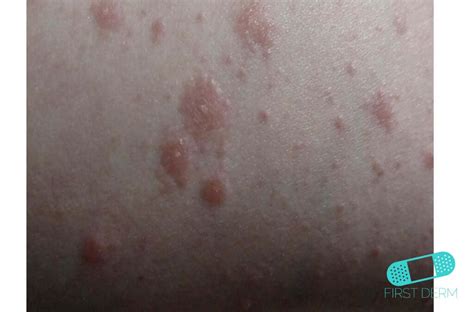Online Dermatology Nummular Eczema Discoid Dermatitis
