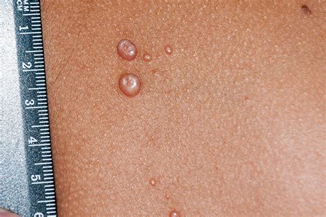 Rashes In Babies And Children Nhs