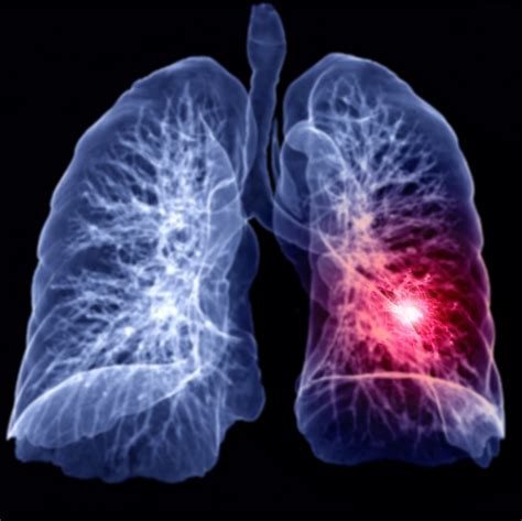 A Ct Scan Can Save Your Lungs And Your Life From Cancer Mcleod Health
