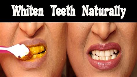 Causes Of Yellow Teeth Ways To Get Whiter Teeth Fast At Home Youtube