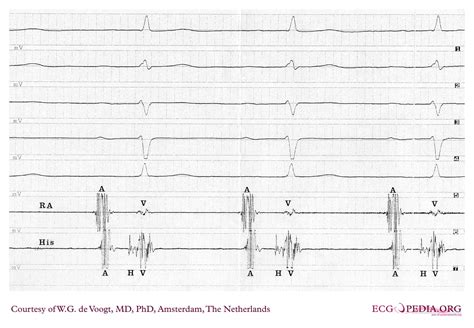 Filedva0666 Ecgpedia