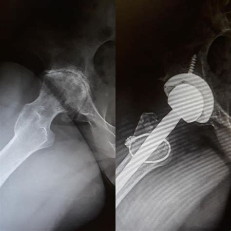 Before And After Hip Replacement Surgery R XRayPorn