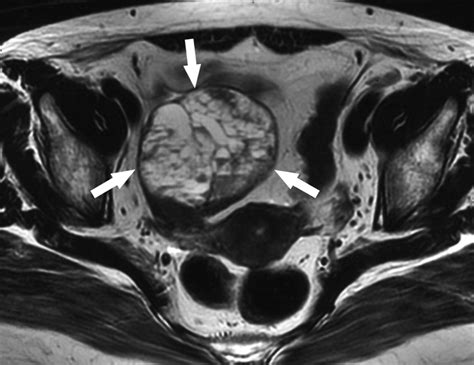 Ct And Mri Findings Of Sex Cord Stromal Tumor Of The Ovary Ajr