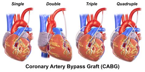 If a ramus intermedius artery is present, the diagonal arteries are. Wiki: Coronary artery bypass surgery - upcScavenger