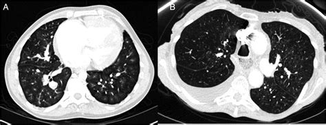 Ct Features Of Pulmonary Arterial Hypertension And Its Major Subtypes