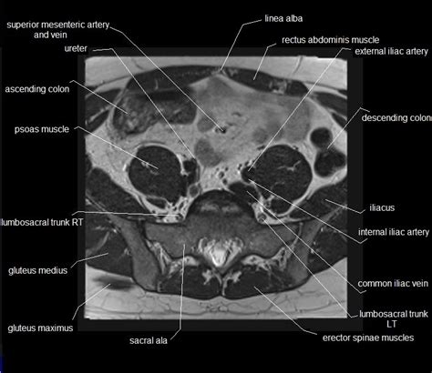 These muscles, including the gluteus maximus and the hamstrings, extend the thigh at the hip in support of the body's weight and propulsion. MRI pelvis anatomy | free male pelvis axial anatomy