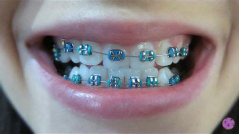 Blue Braces For Teeth Braces Brackets Metalicos Ligas Para