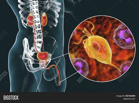 Trichomoniasis Infection In Man 3d Illustration Showing Male Anatomy Of Genitourinary System