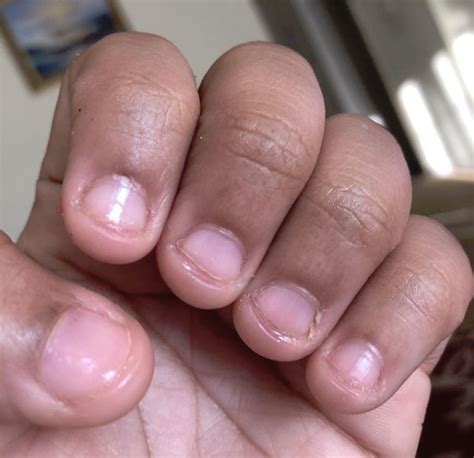 How To Stop Biting Your Nails Daily Sun