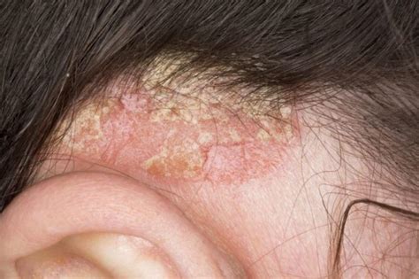 Adolescents With Bodyscalp Psoriasis Benefit From Combination Calbd