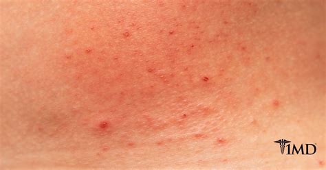 Causes Of Skin Rash 1md Nutrition™