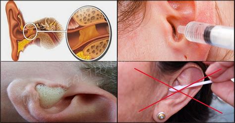 The Right Way To Clean The Ears Ear Wax Buildup Ear Wax Candle Dry