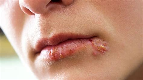 How To Cover Up A Cold Sore Scab Without Makeup