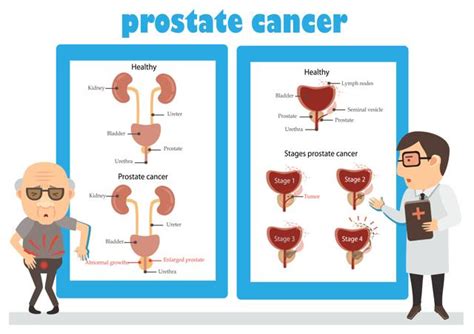 Signs Symptoms Risks Of Prostate Cancer Ocesa Hot Sex Picture