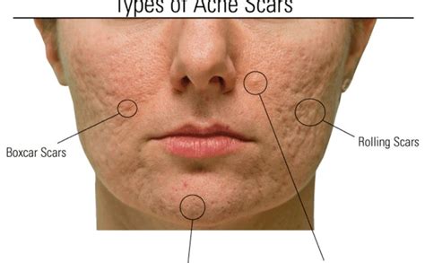 Acne Scar Types