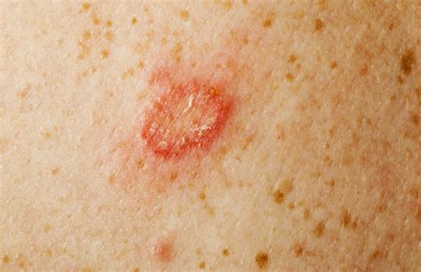 Ringworm In Adults Ringworms