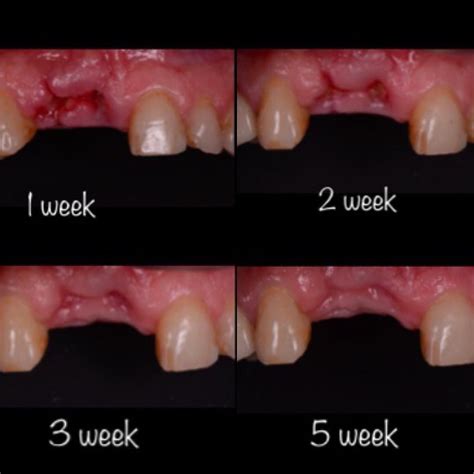 Sequence Of Soft Tissue Healing After Teeth Extraction Dentistry