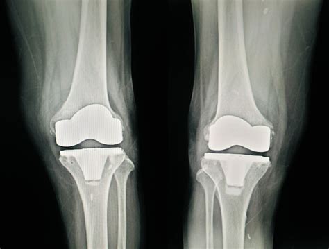 X Ray Image Of Lateral And Anteroposterior Right Knee Joint With Total
