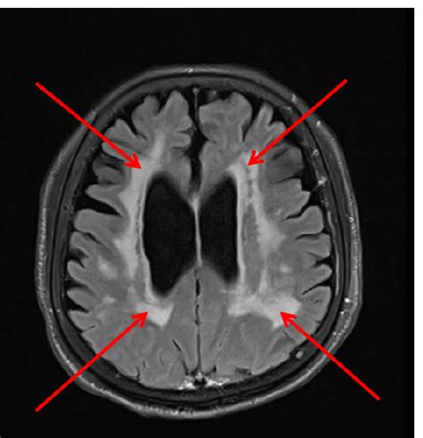 Cerebral Small Vessel