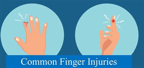 Finger Injury Compensation Guide 2023 Update