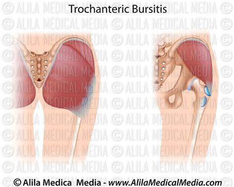 Alila Medical Media Trochanteric Bursitis Unlabeled Medical My Xxx